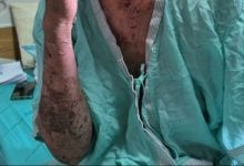 Thai vendor nearly dies after shingles treated with folk remedy | Thaiger