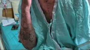 Thai vendor nearly dies after shingles treated with folk remedy | Thaiger