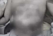 Chon Buri doctor allegedly pours hot water over 3 year old boy during treatment | Thaiger