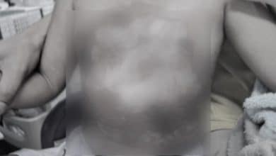 Chon Buri doctor allegedly pours hot water over 3 year old boy during treatment | Thaiger