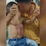 Chon Buri clinic closed temporarily after hot water treatment on 3 year old boy | Thaiger