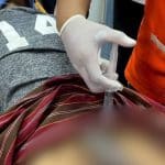 Thai man locks penis with 2 rings over fear of genital theft | Thaiger