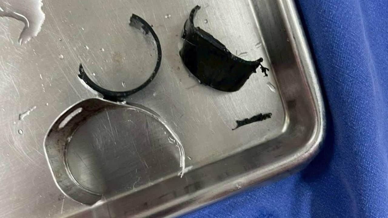 Rescuers remove rings from man's penis who was feared his private part would be stolen