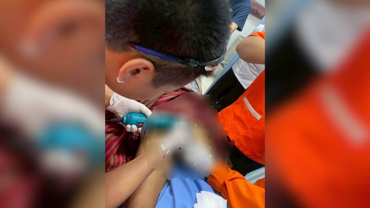 Buriram man places rings on penis in fear of theft