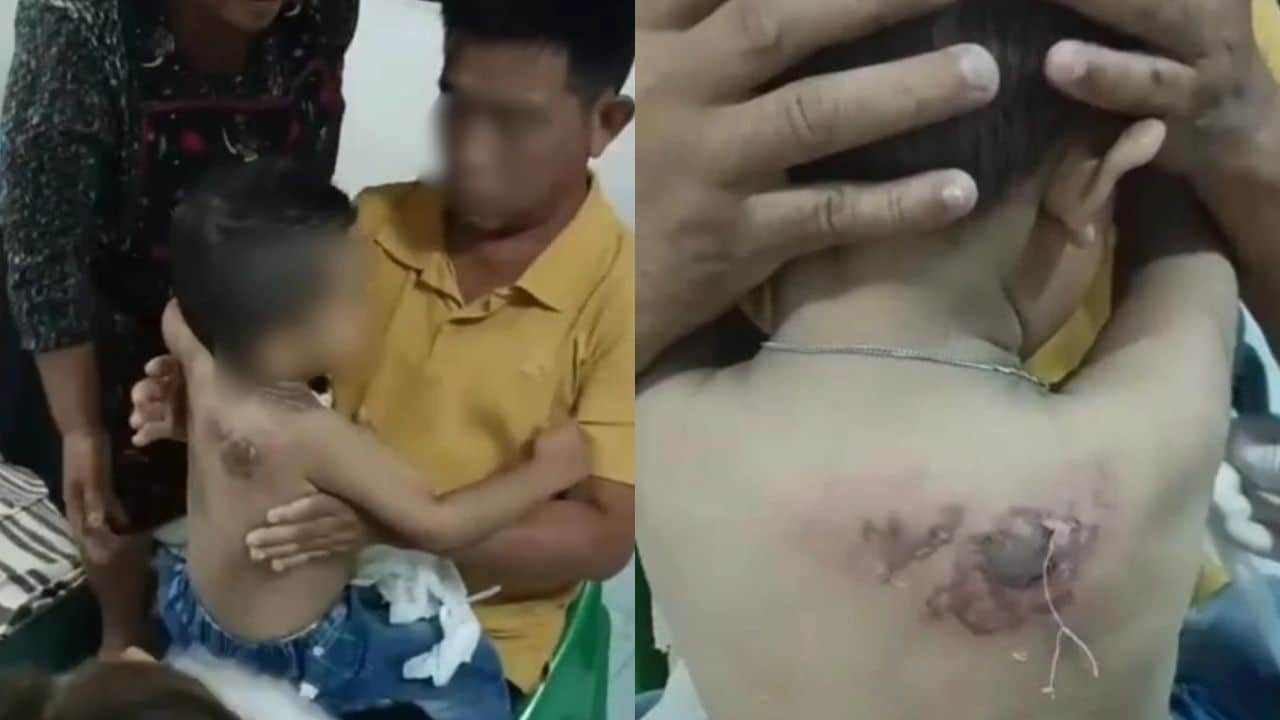 Thai boy suffers severe burn after doctor pours hot water over him