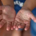 Bangkok kids hit hardest as flu and HFMD cases skyrocket | Thaiger