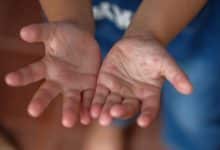 Bangkok kids hit hardest as flu and HFMD cases skyrocket | Thaiger