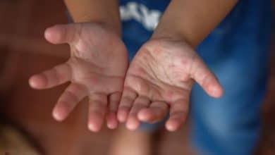 Bangkok kids hit hardest as flu and HFMD cases skyrocket | Thaiger