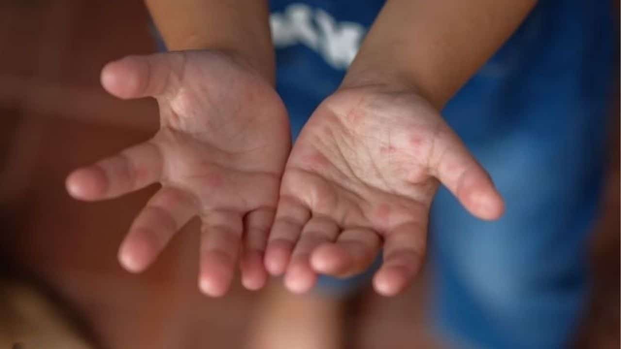 Дети в Бангкоке наиболее пострадали, поскольку случаи гриппа и HFMD резко возросли