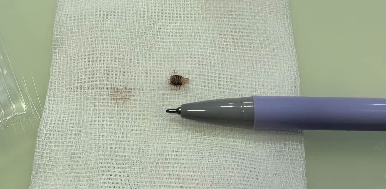 Panic erupts after larva found on foreigner