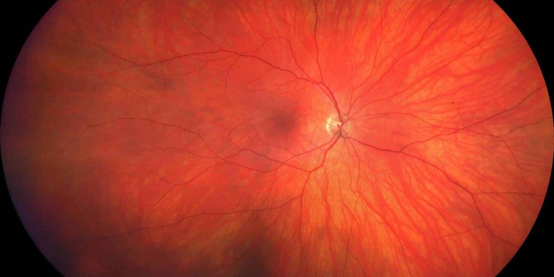 Diabetic retinopathy up close
