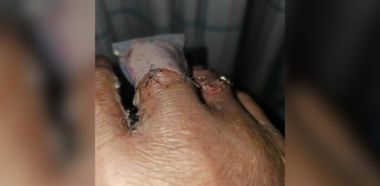 Thai illegal worker lost fingers at work but got no compensation