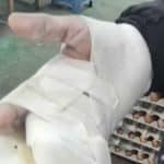 Thai illegal worker in South Korea seeks help after losing fingers while working | Thaiger