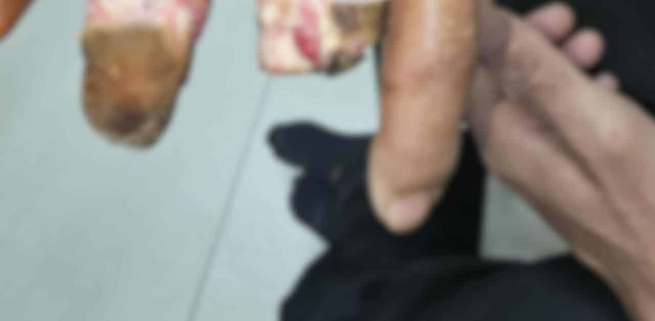 Thai Phee Noi seeks compensation over finger loss