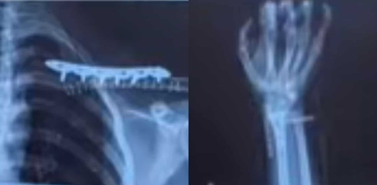 Foreigner injured in car accident, another motorcyclist killed