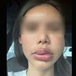 Pattaya filler disaster leaves woman with swollen face for 2 years | Thaiger