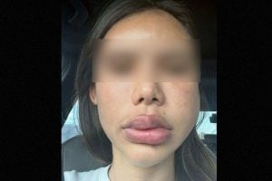Pattaya filler disaster leaves woman with swollen face for 2 years | Thaiger
