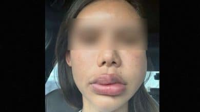 Pattaya filler disaster leaves woman with swollen face for 2 years | Thaiger