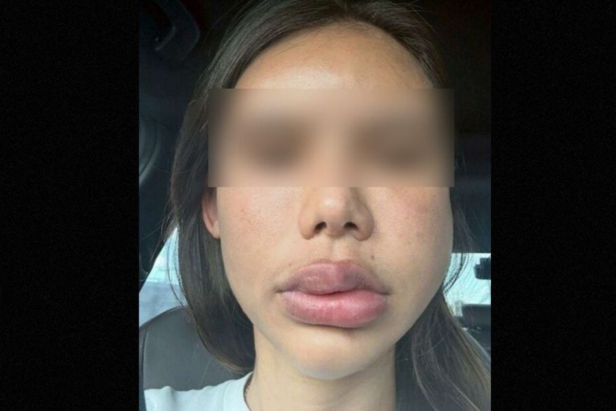 Pattaya filler disaster leaves woman with swollen face for 2 years | Thaiger