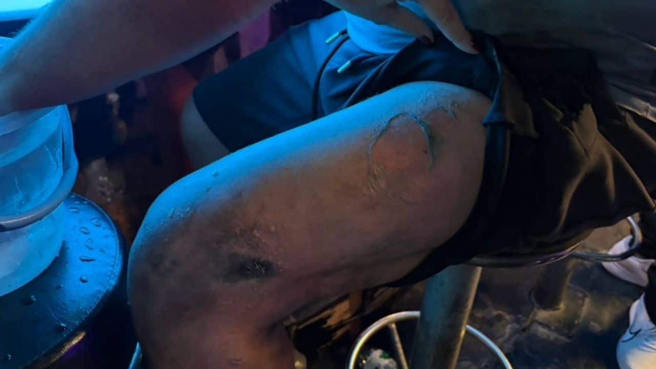 Foreign man injured in Pattaya bar