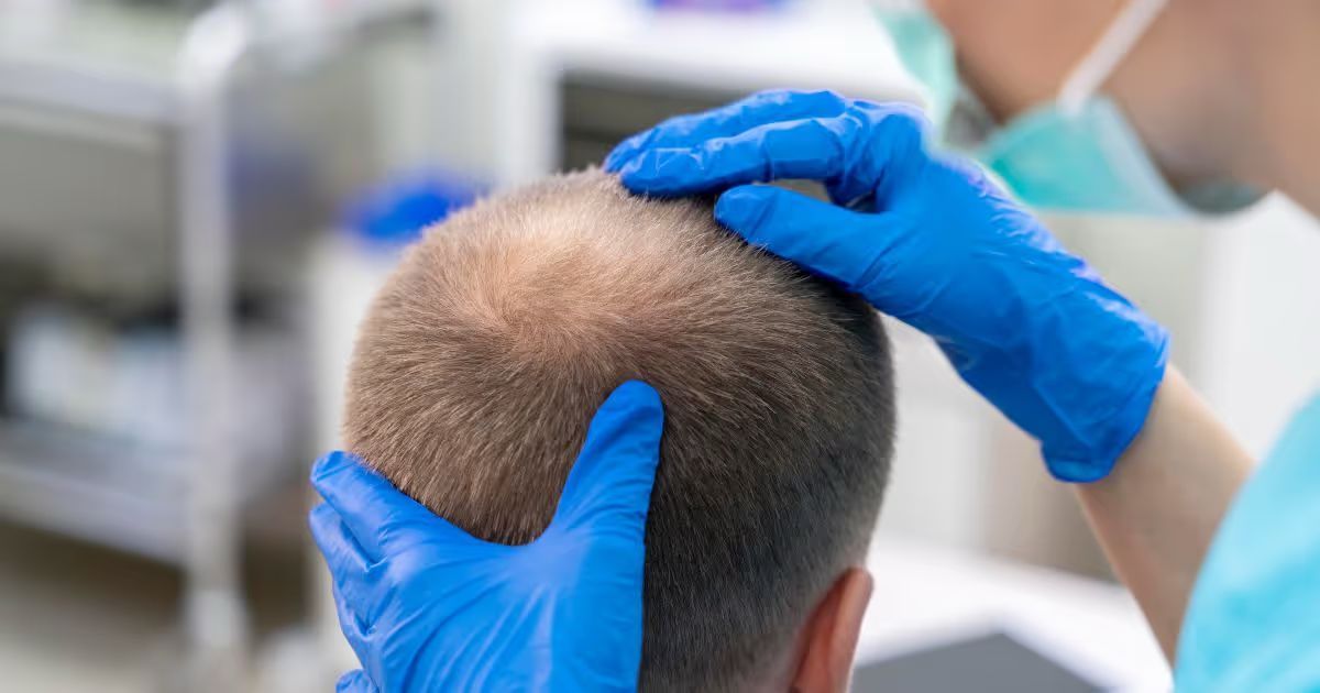 What you need to know before getting a hair transplant in Thailand | News by Thaiger