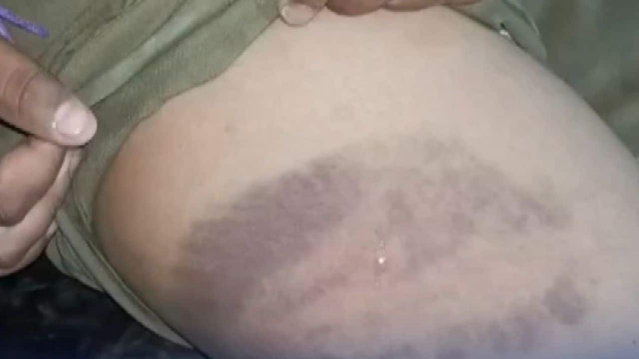 Visible bruises on Thai boy’s arm and leg after domestic abuse in Prachin Buri