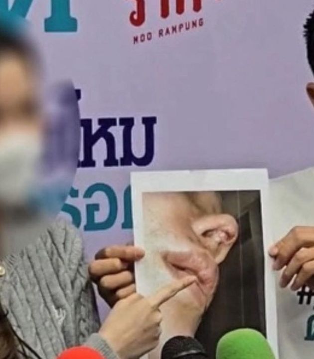Influencer seeks refund over 400,000 baht nose surgery in Bangkok