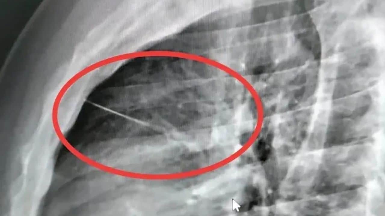 Needle nearly pierces heart