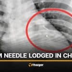 Buriram man finds 7-centimetre needle near heart after chest injury | Thaiger