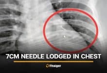 Buriram man finds 7-centimetre needle near heart after chest injury | Thaiger