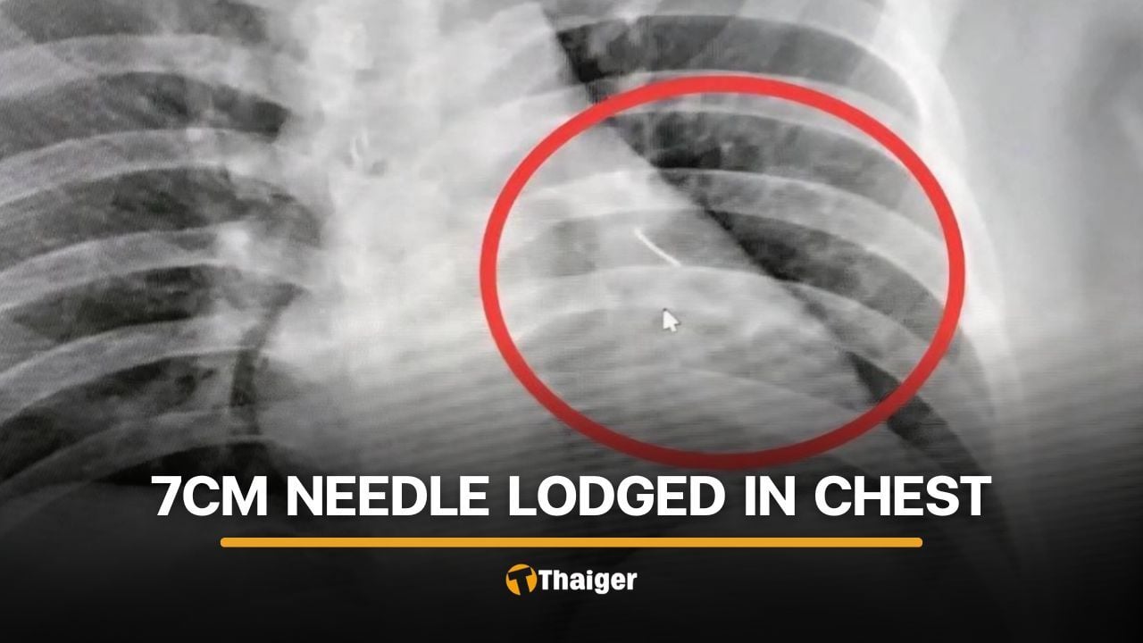 Buriram man finds 7-centimetre needle near heart after chest injury | Thaiger