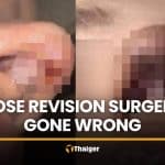 Influencer seeks refund over 400,000 baht nose surgery in Bangkok | Thaiger