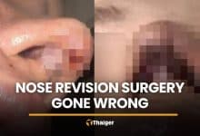 Influencer seeks refund over 400,000 baht nose surgery in Bangkok | Thaiger