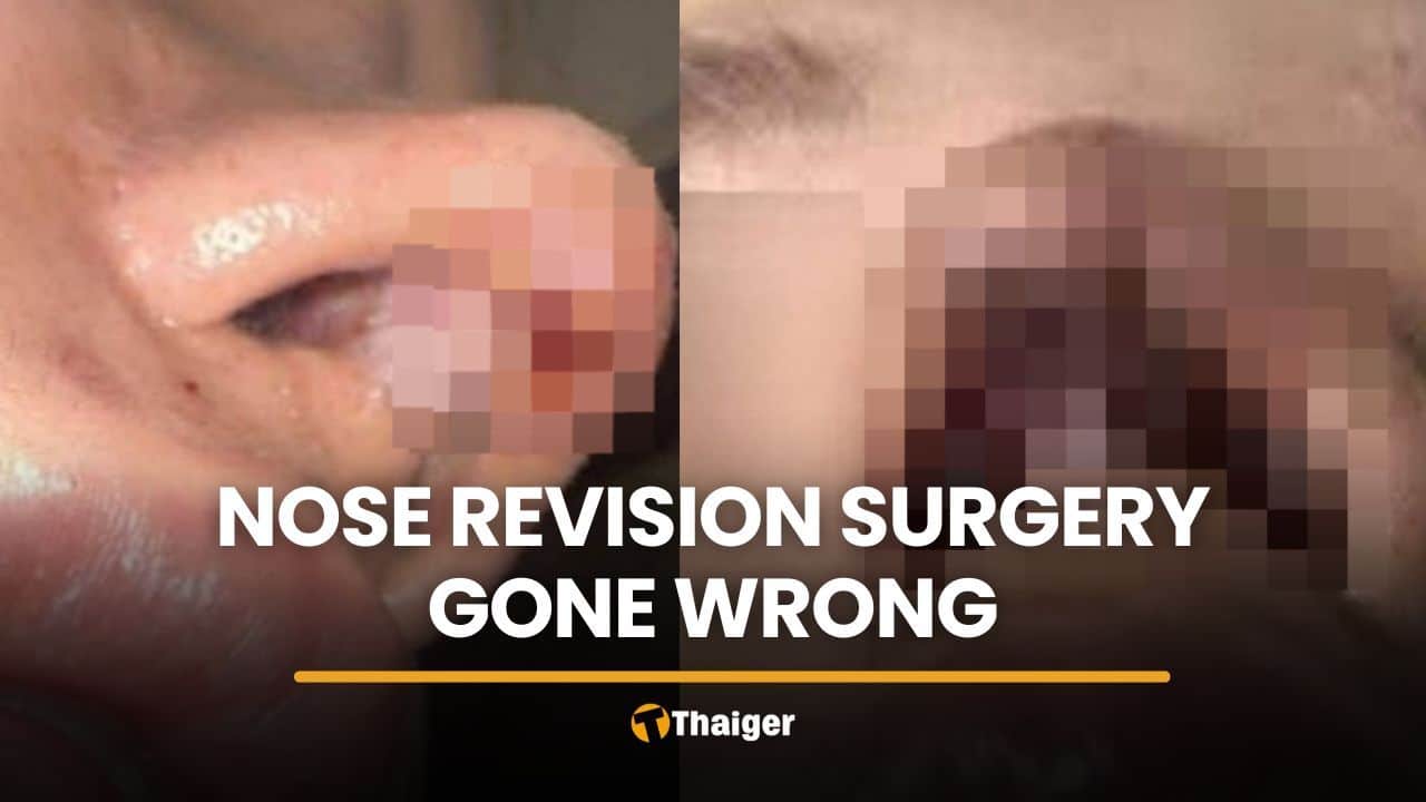 Influencer seeks refund over botched 400,000 baht nose surgery in Bangkok | Thaiger