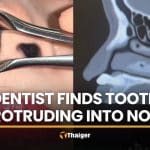 Thai dentist stunned by tooth protruding into patient’s nose | Thaiger