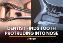 Thai dentist stunned by tooth protruding into patient’s nose | Thaiger