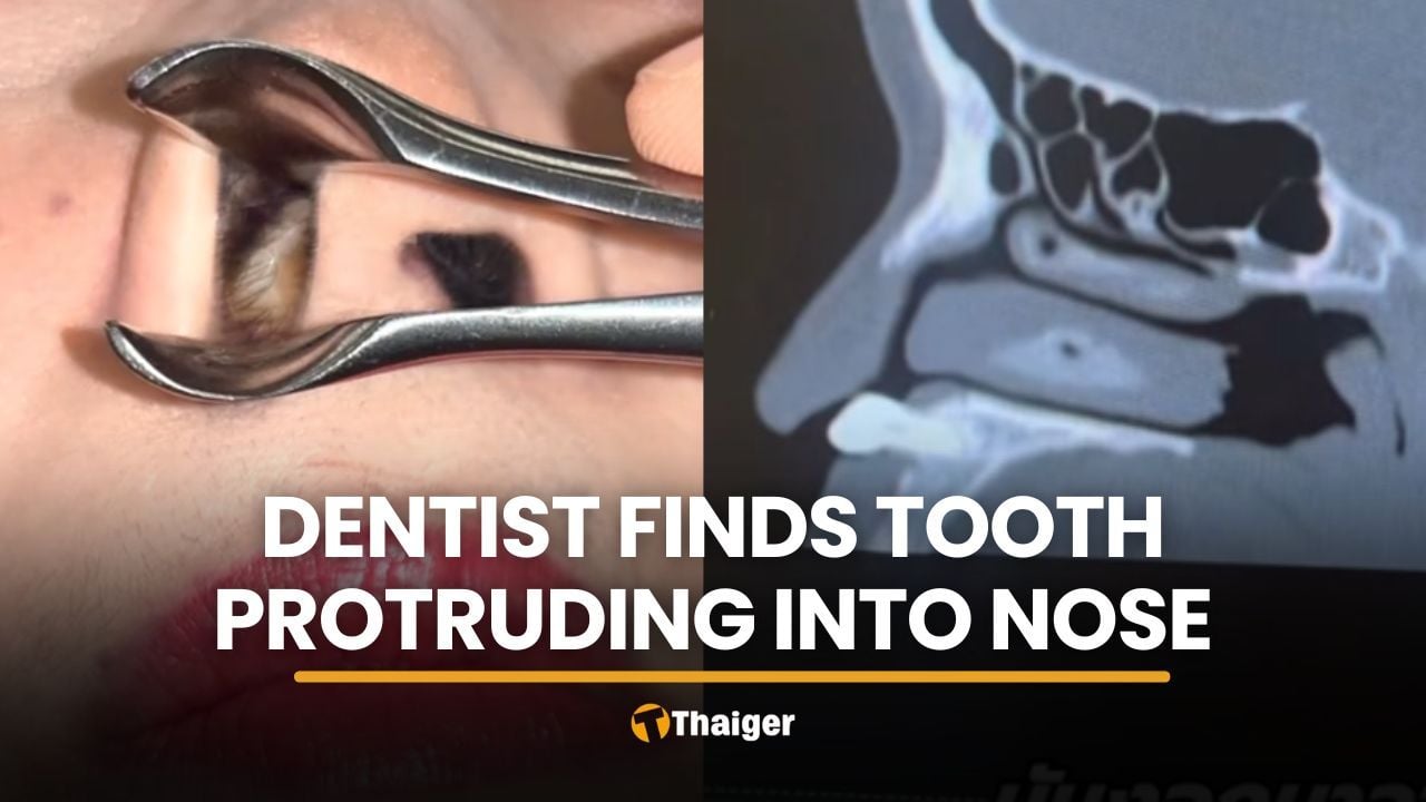 Thai dentist stunned by tooth protruding into patient’s nose | Thaiger