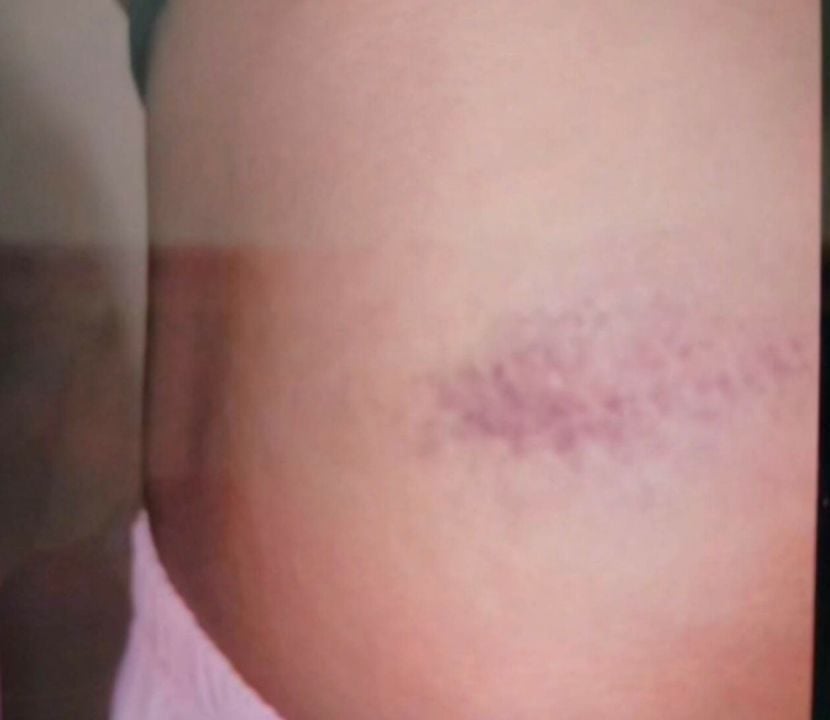 Chon Buri student left with wounds after homework punishment
