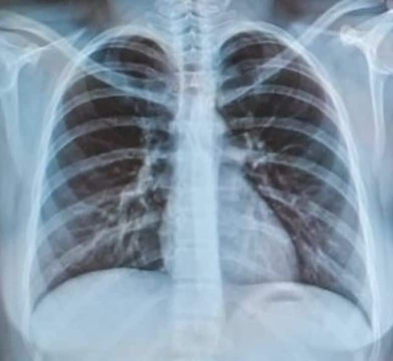 A Chiang Mai doctor said PM2.5 and toxic smoke were linked to serious lung cases, including a young tourist who required oxygen treatment.