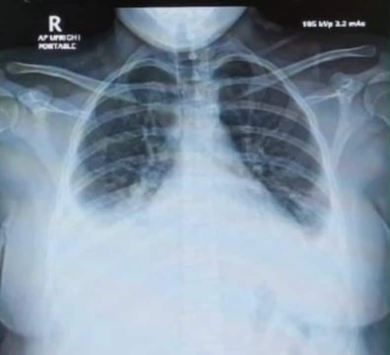 A Chiang Mai doctor said PM2.5 and toxic smoke were linked to serious lung cases, including a young tourist who required oxygen treatment.