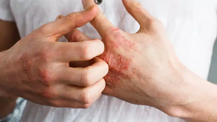 Monsoon season linked to rise in fungal skin infections and eczema across Thailand and Southeast Asia | News by Thaiger