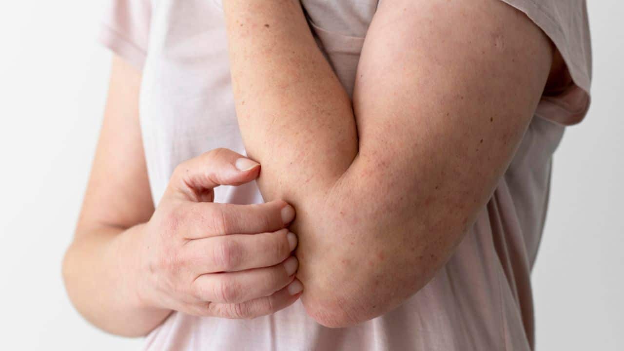 Mpox cases in Thailand have reached 48 this year, with health officials monitoring possible infections after the Songkran period.