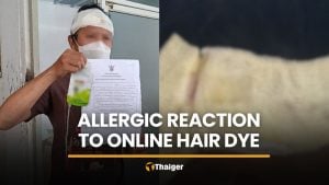Online hair dye leaves Ratchaburi man with severe allergic reaction | Thaiger
