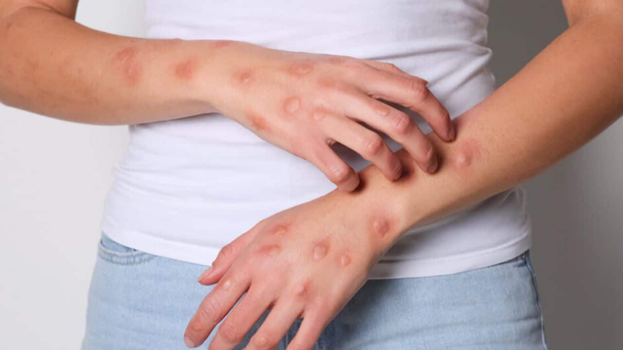 Thailand has reported new Mpox cases, including a foreign tourist, as health officials urge people to monitor symptoms.